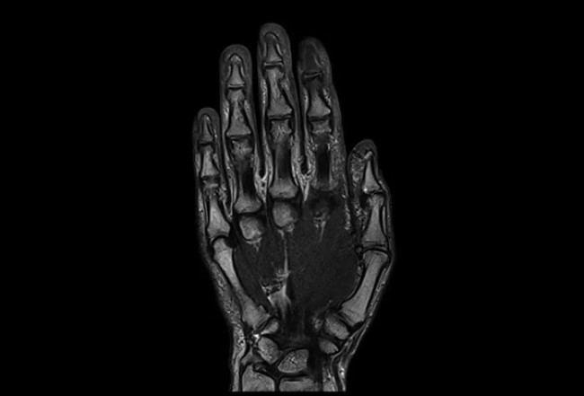 Магнитно-резонансная томография руки