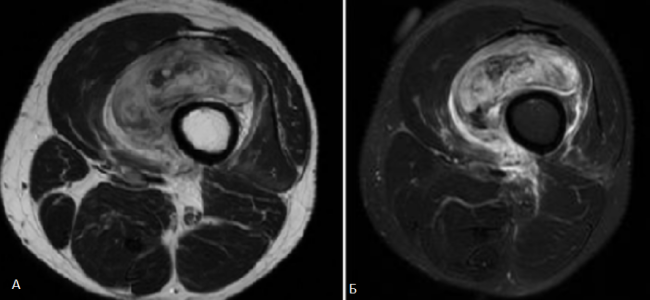 На снимках объемное образование внутри промежуточной мышцы бедра: А - нативное Т1 ВИ, неоднородная масса, Б - после введения гадолиния видно интенсивное накопление парамагнетика, гиперваскуляризация