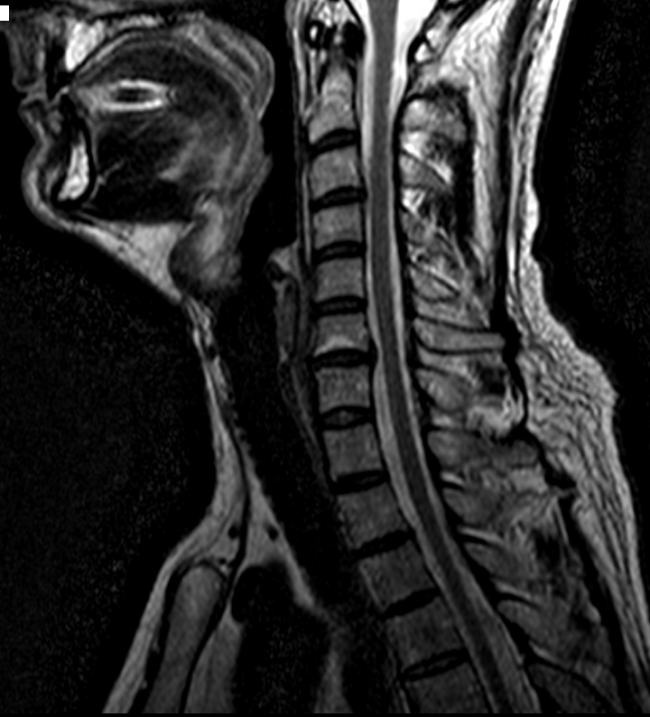 МРТ: В рассматриваемой анатомической области визуализируется грыжа межпозвонкового диска
