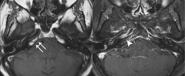 МРТ головного мозга в аксиальной проекции: визуализация височной кости (стрелка указывает расположение VIII черепного нерва)