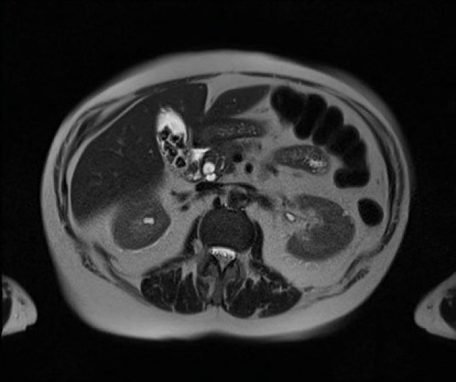 Желчекаменная болезнь на фото МРТ