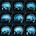 Сколько по времени делается МРТ головного мозга? 