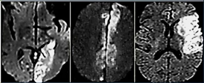  МР-снимки головного мозга в DWI режиме