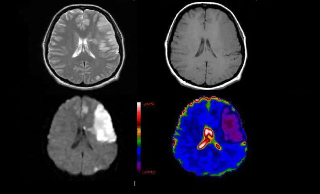 Локальная ишемия мозга при разных режимах магнитной нейровизуализации