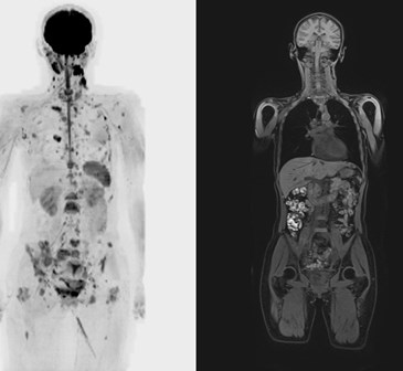 Снимок всего тела в режиме диффузионной МР-томографии
