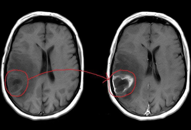  Обнаружение опухоли при выполнении МРТ головного мозга после введение контраста (отмечена красным) 