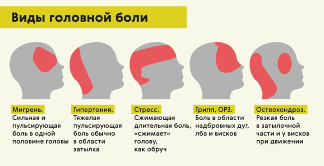 Схематическое изображение боли в области головы при различных заболеваниях