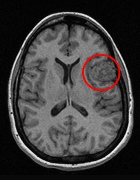  Новообразование, обнаруженное при проведении МР-сканирования головного мозга