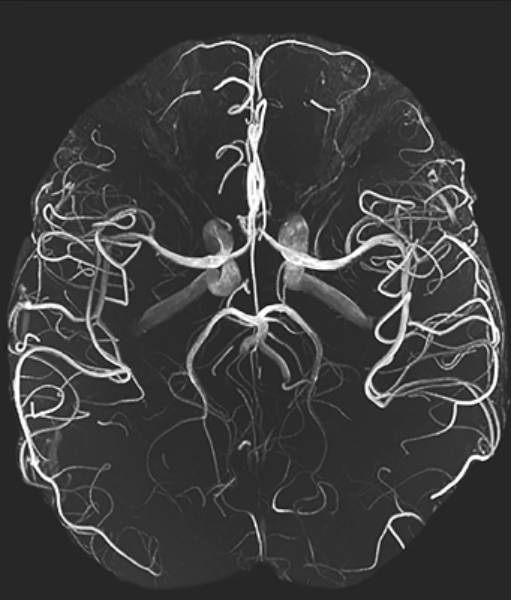  Снимок сосудов головного мозга, полученный при МР-ангиографии 