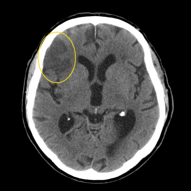 При проведении компьютерной томографии головы диагностирован ишемический инсульт (зона поражения обведена желтым)