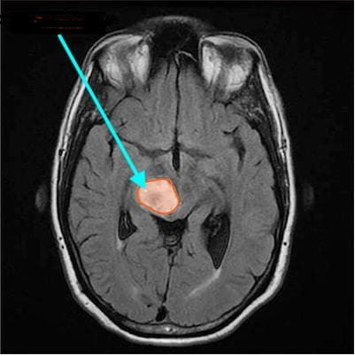 При проведении МР-сканирования головы обнаружена опухоль, при дальнейшем изучении диагностирована глиома (выделена стрелкой)
