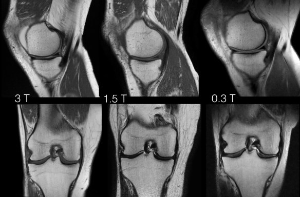  Изображения коленного сустава на МРТ-аппаратах различной мощности (слева - 3 Тесла, посередине - 1,5 Тесла, справа - 0,3 Тесла)