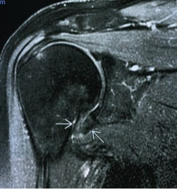 Утолщение суставной капсулы в области подмышечного заворота (указано стрелками)