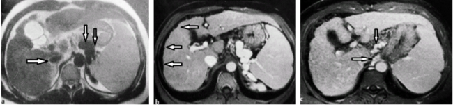 Магнитно-резонансные томограммы при циррозе печени: Т2 ВИ, нативный снимок - спленомегалия, увеличение просвета селезеночной вены (а); Т1 ВИ, постконтрастное изображение, артериальная фаза - волнистость контуров органа (стрелки) подтверждение варикозного расширения селезеночной вены (в); Т1 ВИ, поздняя портальная венозная фаза - множественные узлы регенерации, придающие пестроту паренхиме железы, расширение вен пищевода (стрелки), изображение (с)