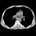 Что показывает компьютерная томография грудной клетки