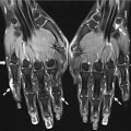 Что показывает МРТ кисти руки