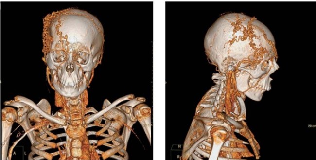 КТ, трехмерная реконструкция: ангиодисплазия в правой лобно-височной области, прослеживается связь с сонными артериями