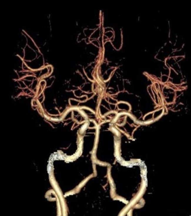 КТ-ангиография сосудов головного мозга, мультипланарная реконструкция
