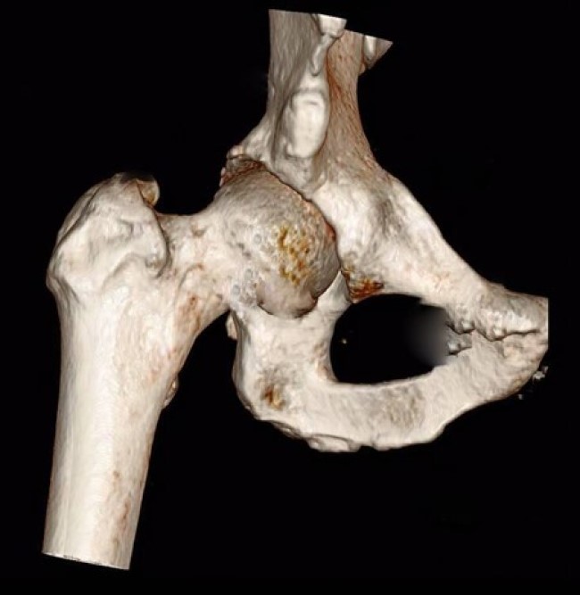 3D-реконструкция тазобедренного сустава