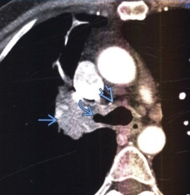 КТ-снимок с контрастом: в правом главном бронхе опухоль, окклюзирующая просвет
