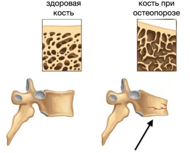 Схематическое изображение изменений при остеопорозе