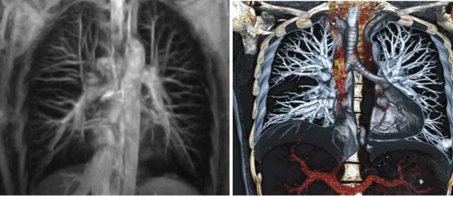 КТ: объемная мультипланарная реконструкция позволяет рентгенологу получить пространственное представление об исследуемых органах