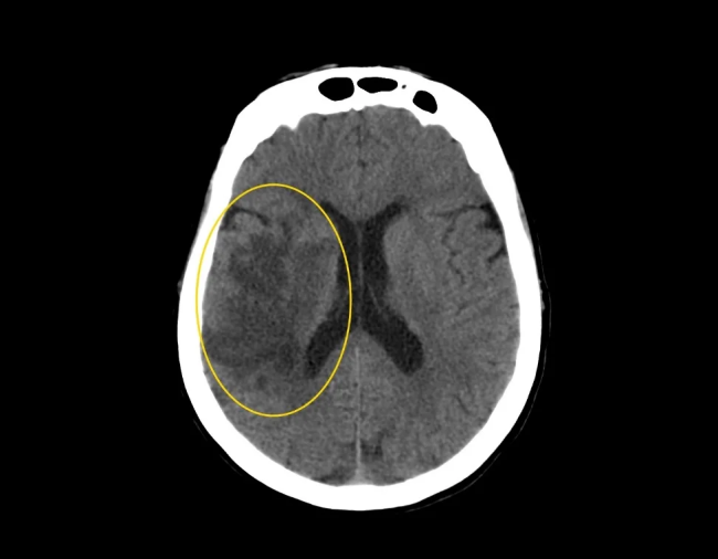 Ишемический инсульт (пораженный участок выделен желтым) на снимке в аксиальной плоскости