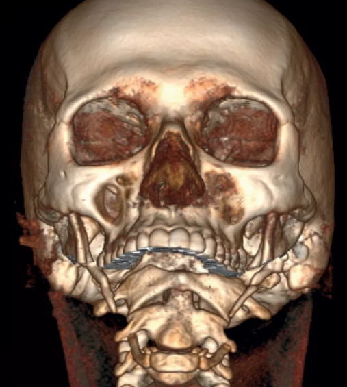 Компьютерная томография костных структур черепа, мультипланарная реконструкция