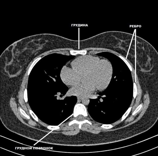 КТ-скан органов грудной клетки в аксиальной проекции