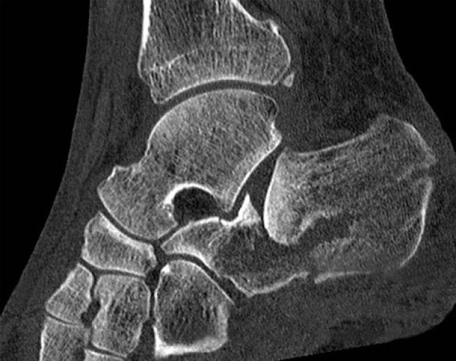 Перелом пяточной кости на КТ-снимке