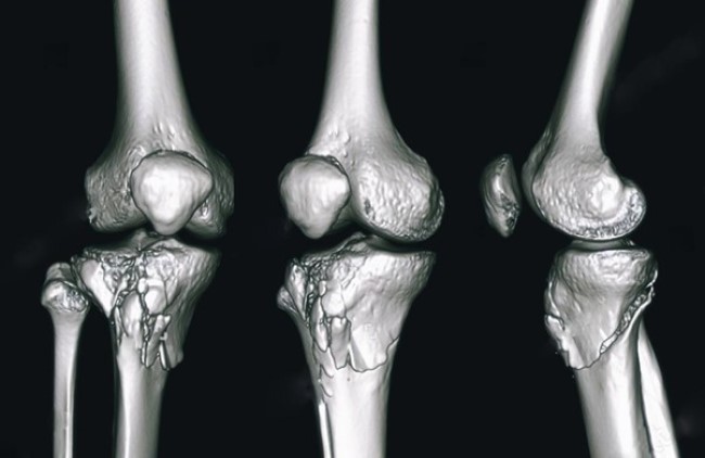3D-реконструкция коленного сустава, выполненная при помощи компьютерного томографа: перелом медиального мыщелка большеберцовой кости