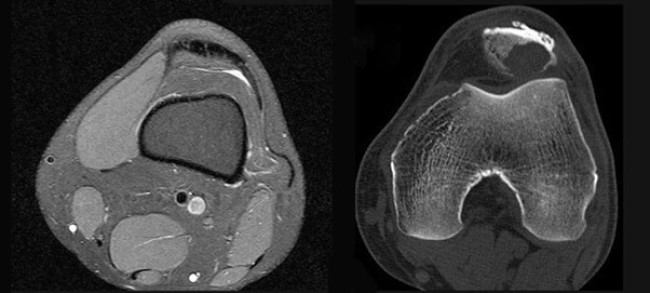 МРТ (слева) и КТ-исследование (справа) колена