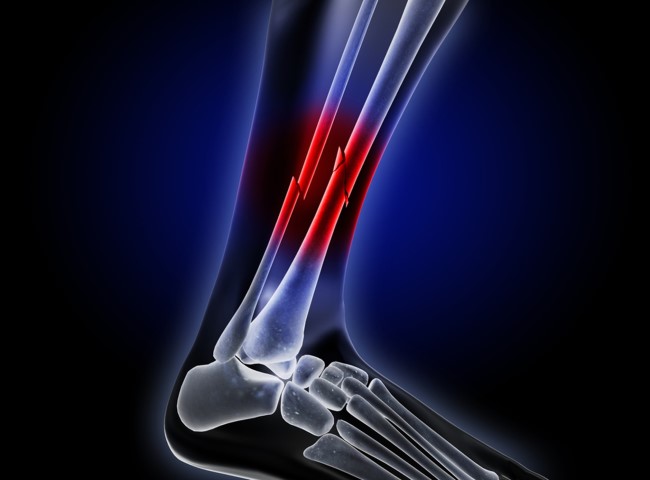 Переломы костей голени занимают первое место среди травматических повреждений длинных трубчатых костей