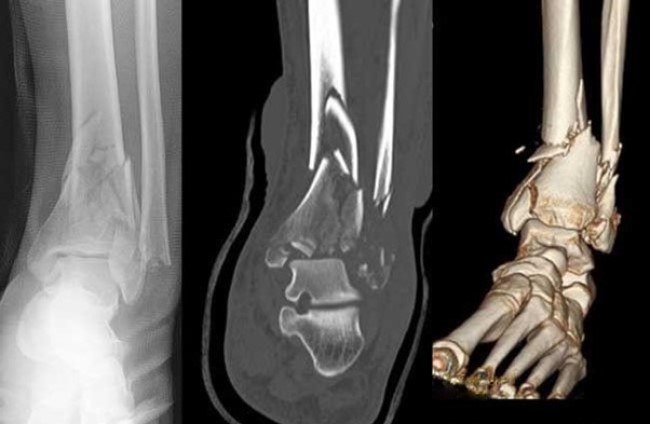 Рентгенограмма, КТ-скан и 3D-реконструкция голеностопного сустава: многооскольчатый перелом мало- и большеберцовой костей с подвывихом и смещением отломков