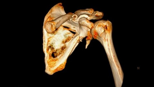 3D-модель костей плечевого пояса: перелом лопатки и ключицы
