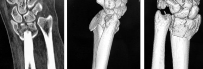 Дистальный перелом лучевой кости