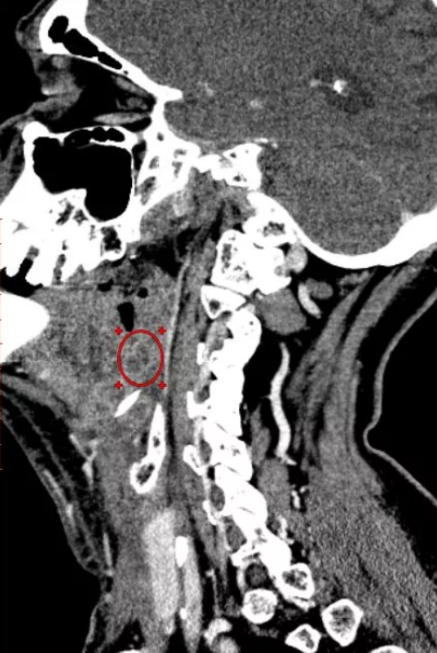 Компьютерная томография шеи: рак гортани (область интереса обведена)