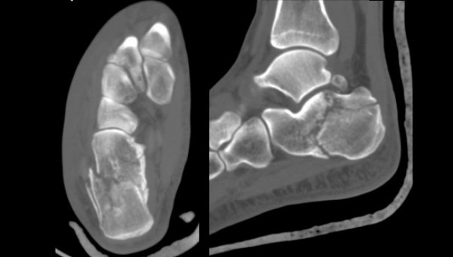 Компьютерная томография: оскольчатый перелом пяточной кости