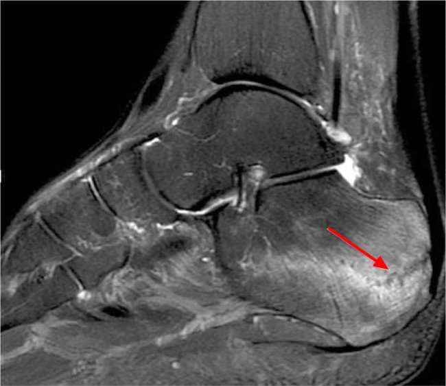 Магнитно-резонансная томография корня стопы: красной стрелкой отмечен стресс-перелом