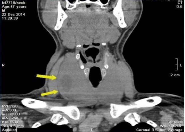 Узловой зоб щитовидной железы (очаговые изменения указаны стрелками)