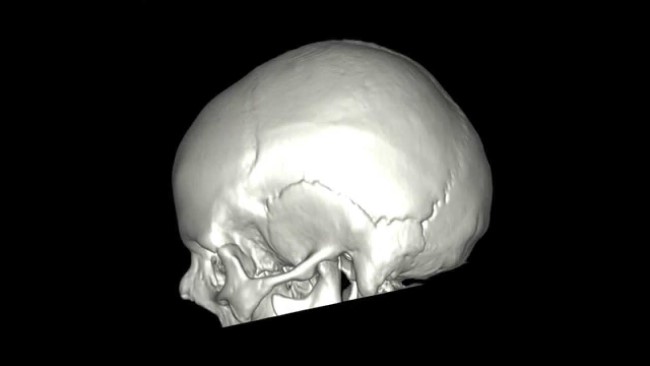 Кости черепа в объеме после компьютерной постпроцессинговой обработки снимков