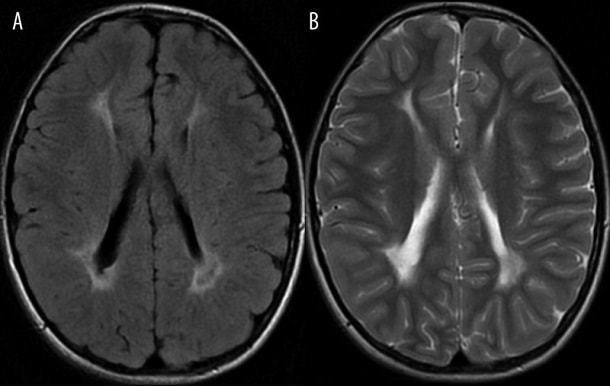 Признаки хронической ишемии церебральных тканей на МРТ