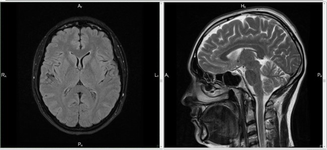 МРТ головы (зона интереса – внутричерепные структуры)