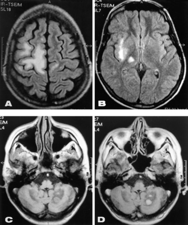 МР-томография головного мозга