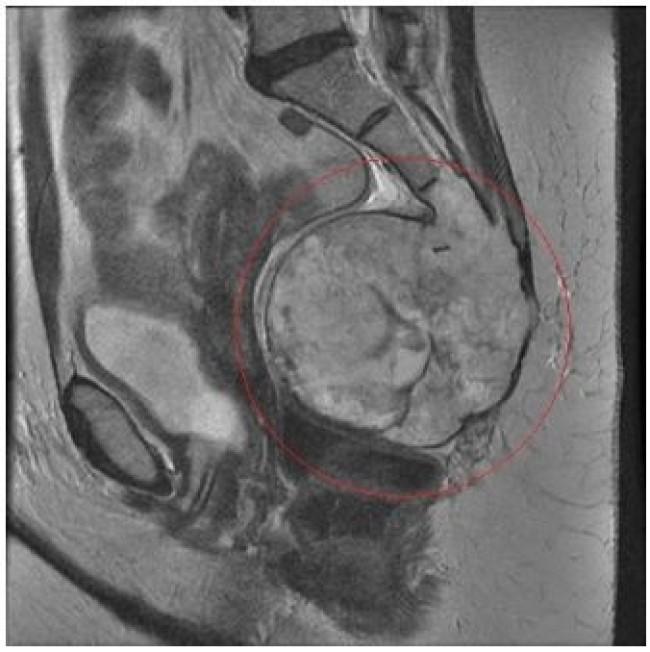 МРТ снимок гигантской опухоли, распространившейся на копчик и крестец