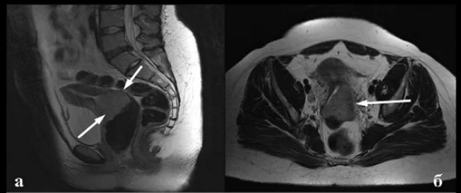 Опухоль шейки матки (стрелки) на МРТ (а - сагиттальная, б - аксиальная проекции)
