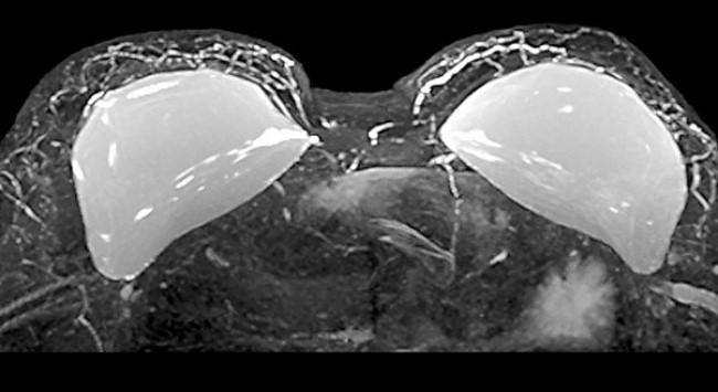 Имплантаты молочных желез на снимке МРТ