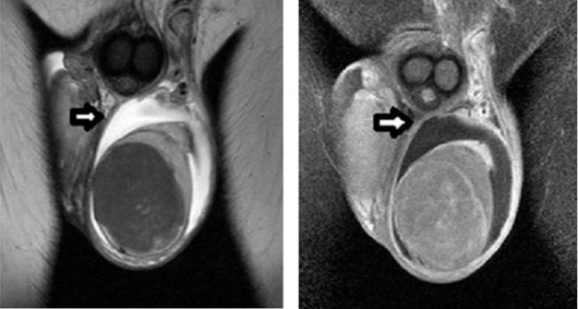 Магнитно-резонансная томография лимфомы яичка (указана стрелкой), нативно и с внутривенным контрастированием