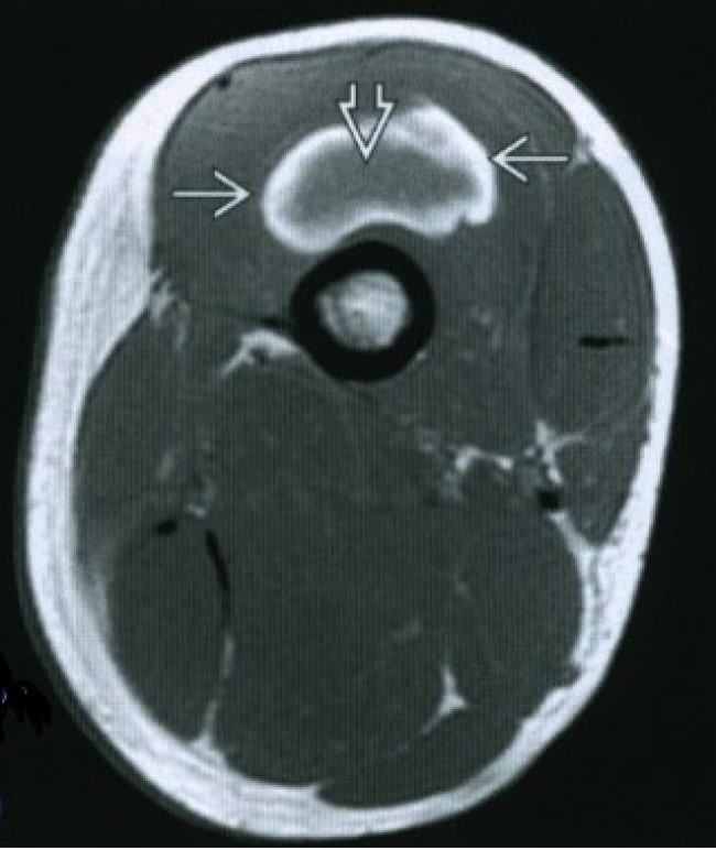 Гематома в мышцах бедра на МР-снимке