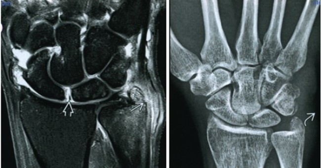 Справа - МРТ кисти, слева - рентгенография